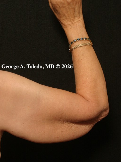 Arm Lift Before and After Before