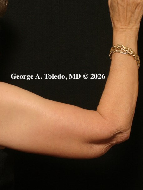 Arm Lift Before and After After
