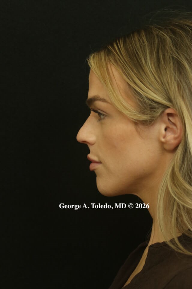 Rhinoplasty Results Dallas Before