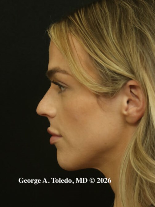 Rhinoplasty Results Dallas Before