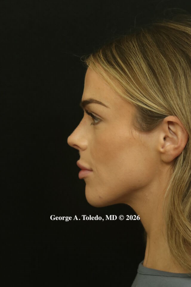 Rhinoplasty Results Dallas After