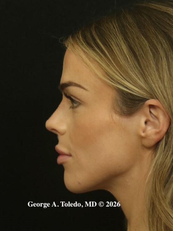 Rhinoplasty Results Dallas After