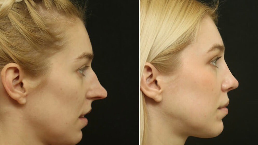 Rhinoplasty Results Dallas, TX