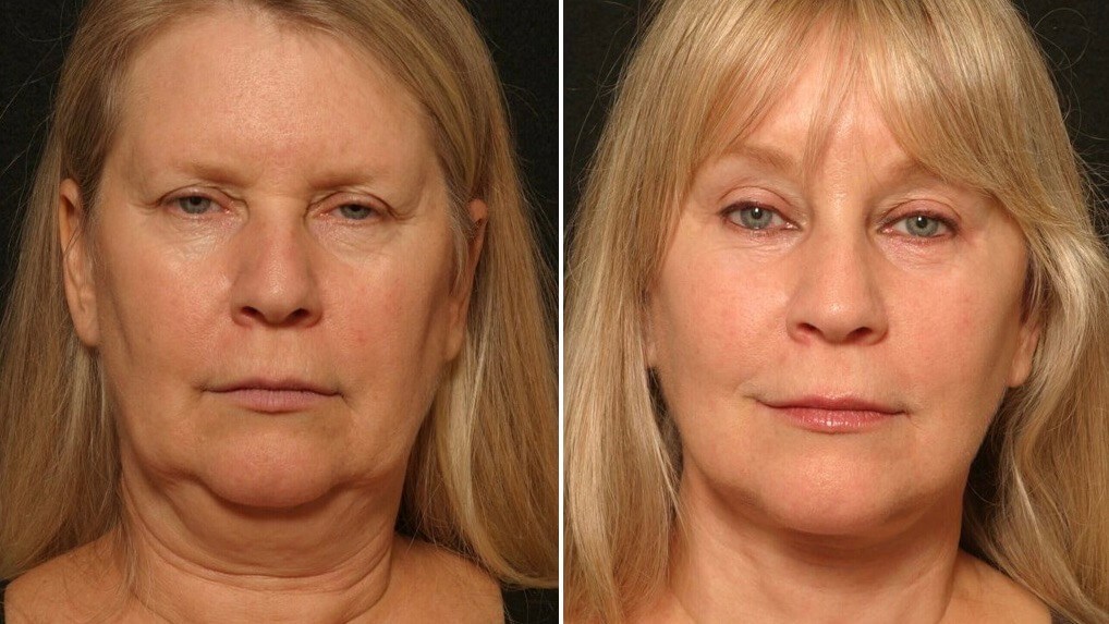 Facelift Results