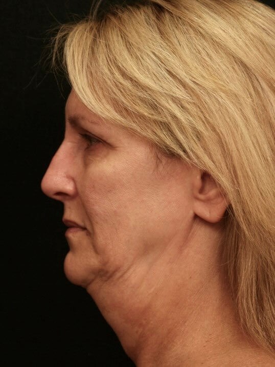 Facelift Before and After After