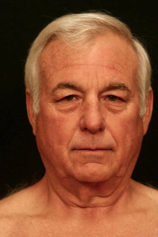 Facelift Before and After Before