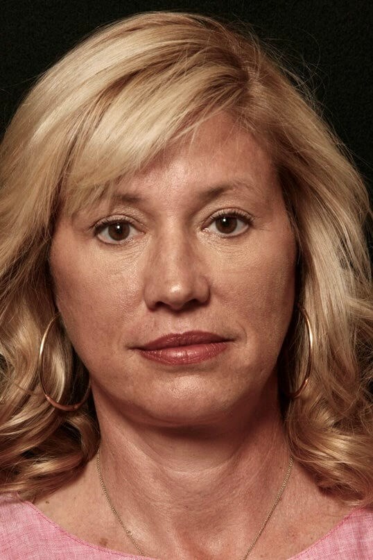 Facelift Before and After After