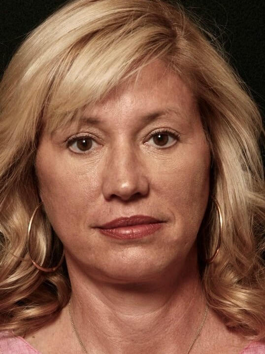 Facelift Before and After After