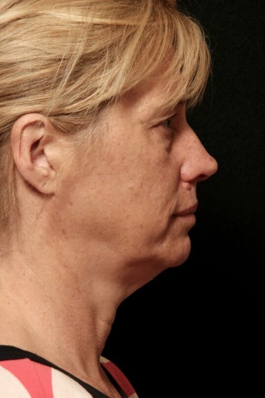 Facelift Before and After Before