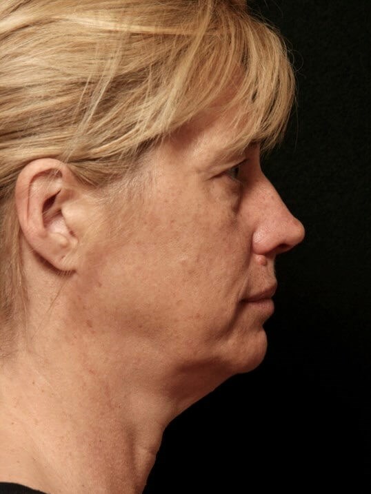 Facelift Before and After Before