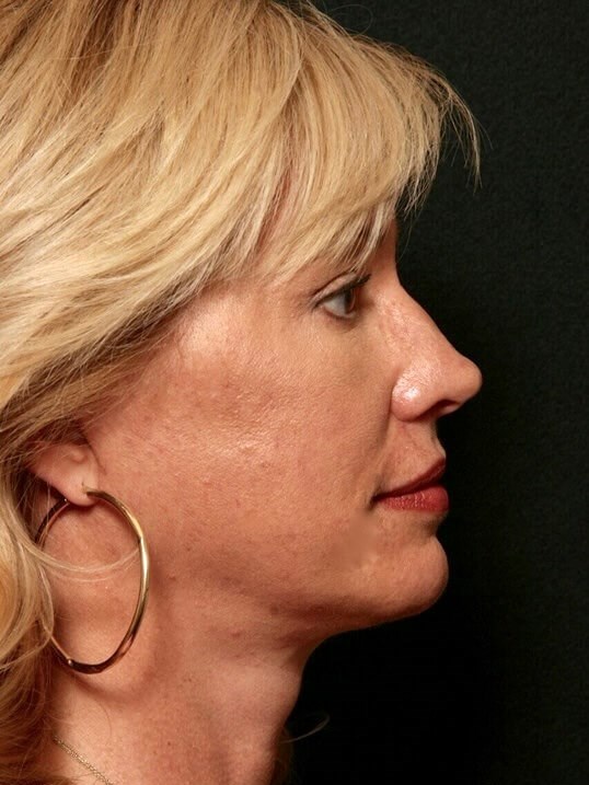 Facelift Before and After After