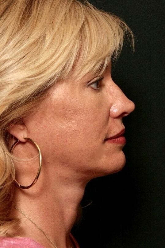 Facelift Before and After After