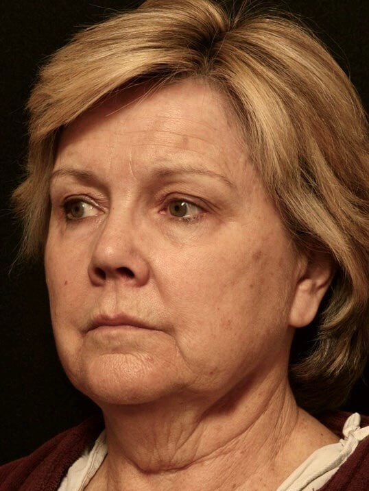 Facelift Before and After Before