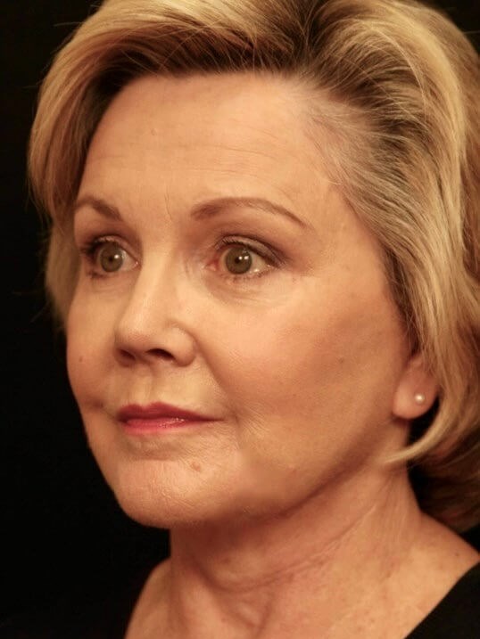 Facelift Before and After After