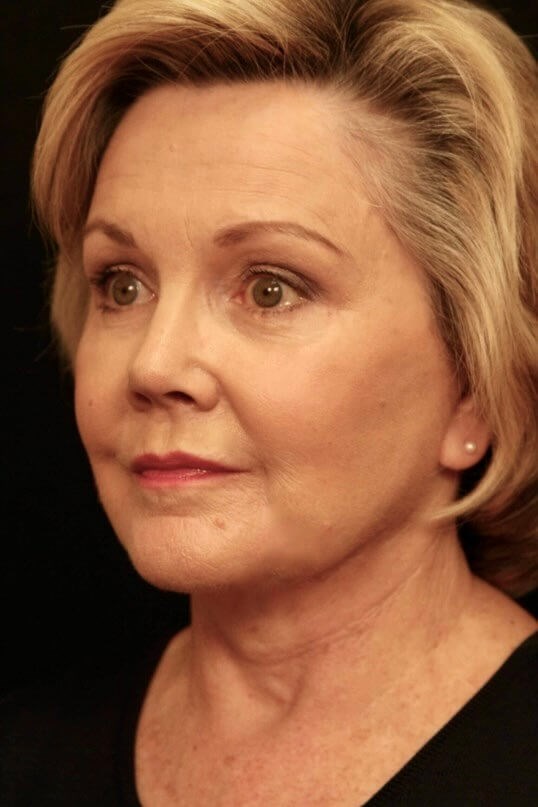 Facelift Before and After After