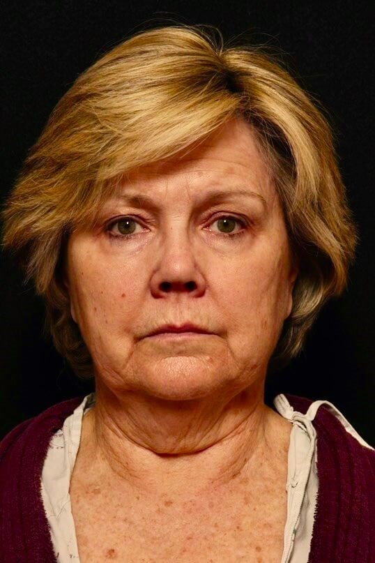 Facelift Before and After Before