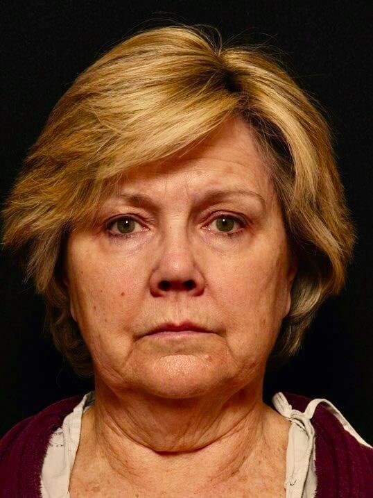 Facelift Before and After Before