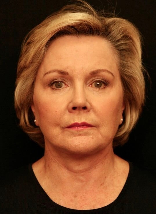 Facelift Before and After After