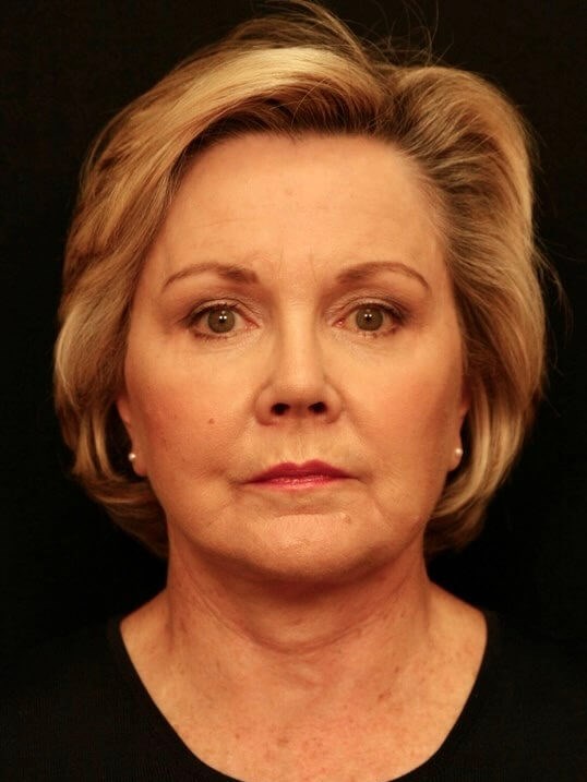 Facelift Before and After After