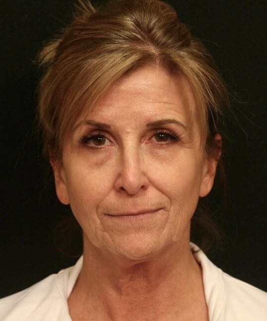 Facelift Before and After Before