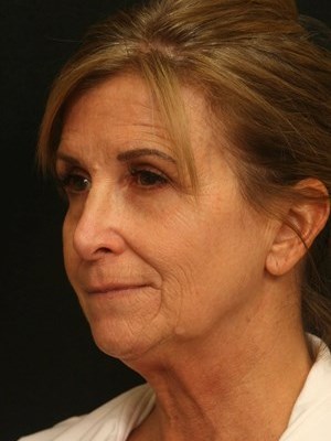 Facelift Before and After Before