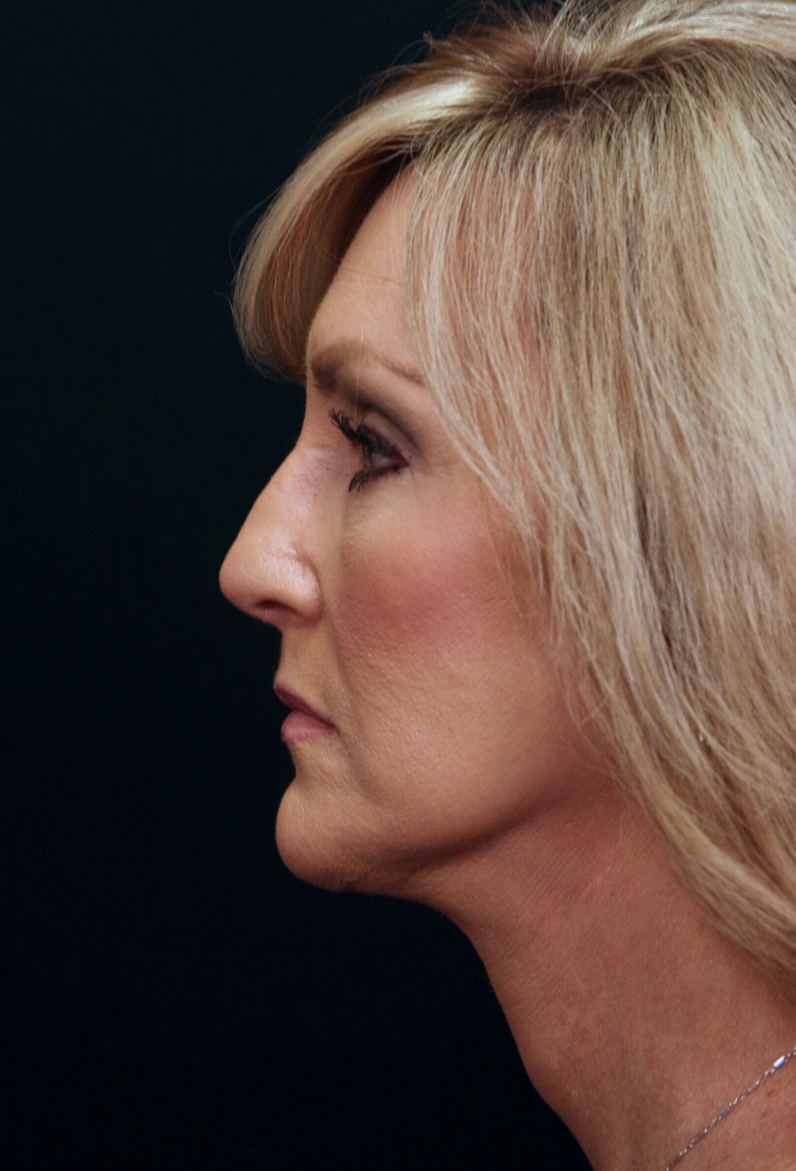 Facelift Before and After After