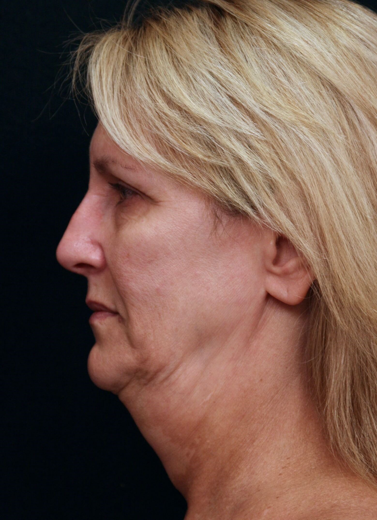 Facelift Before and After Before