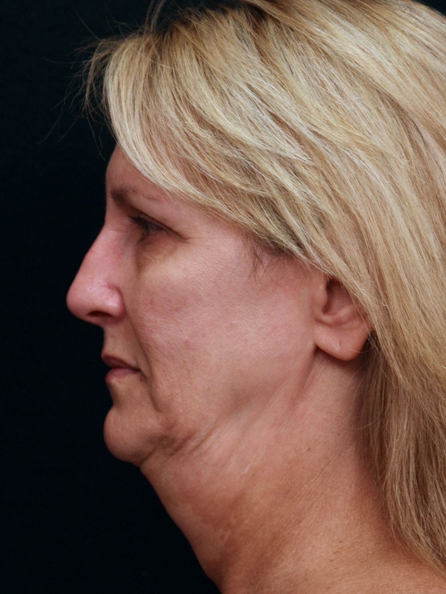 Facelift Before and After Before