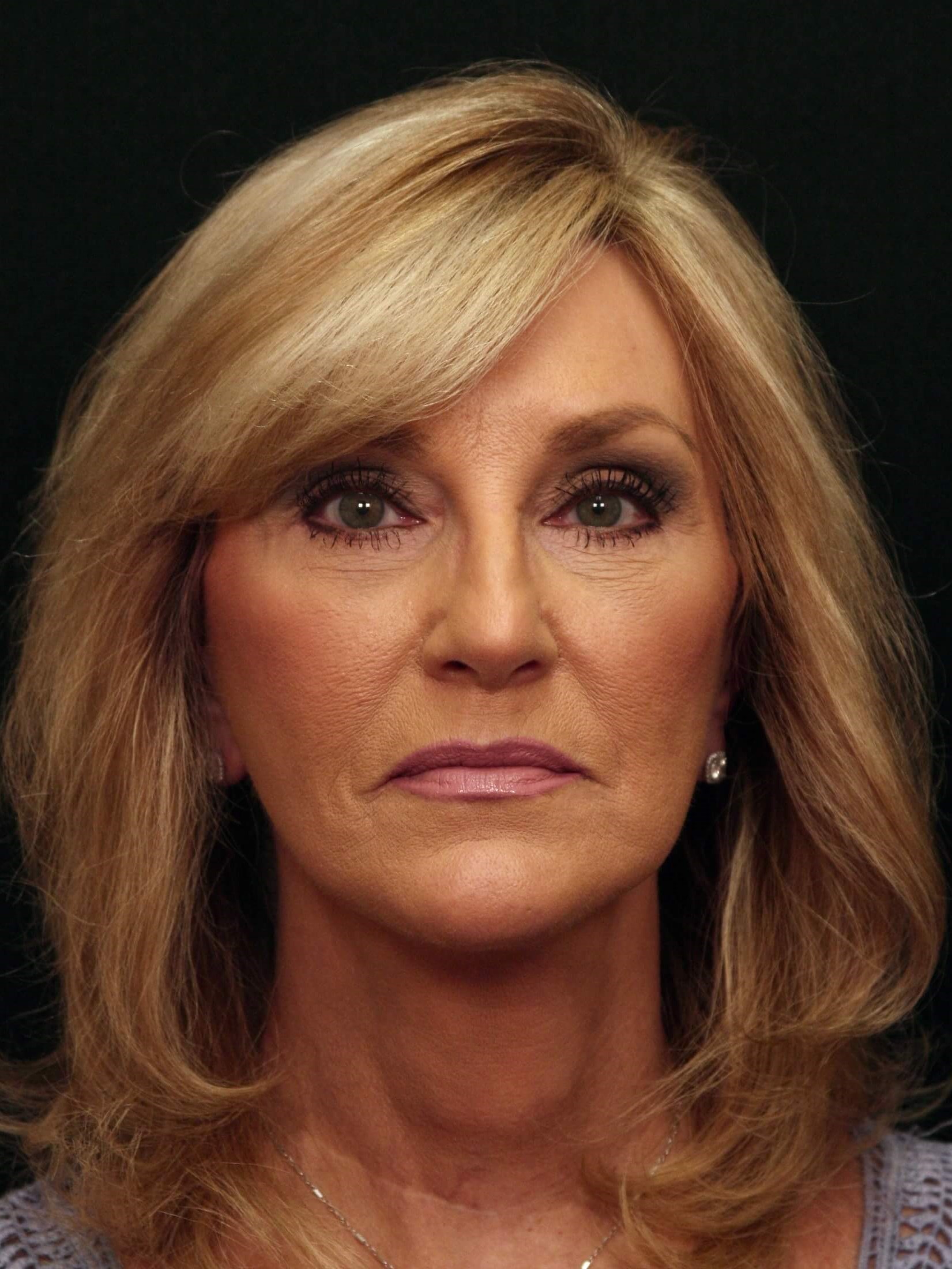 Facelift Before and After After