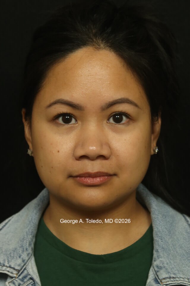 Nasal Implant Results Before