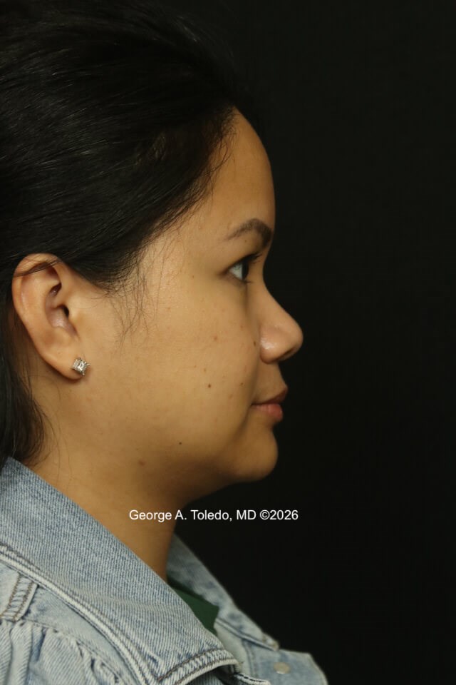 Nasal Implant Results Before