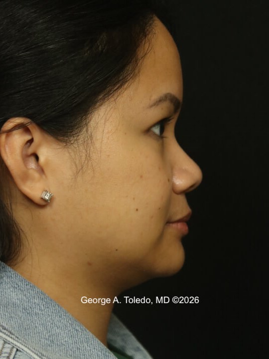 Nasal Implant Results Before