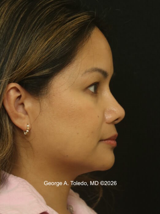 Nasal Implant Results After