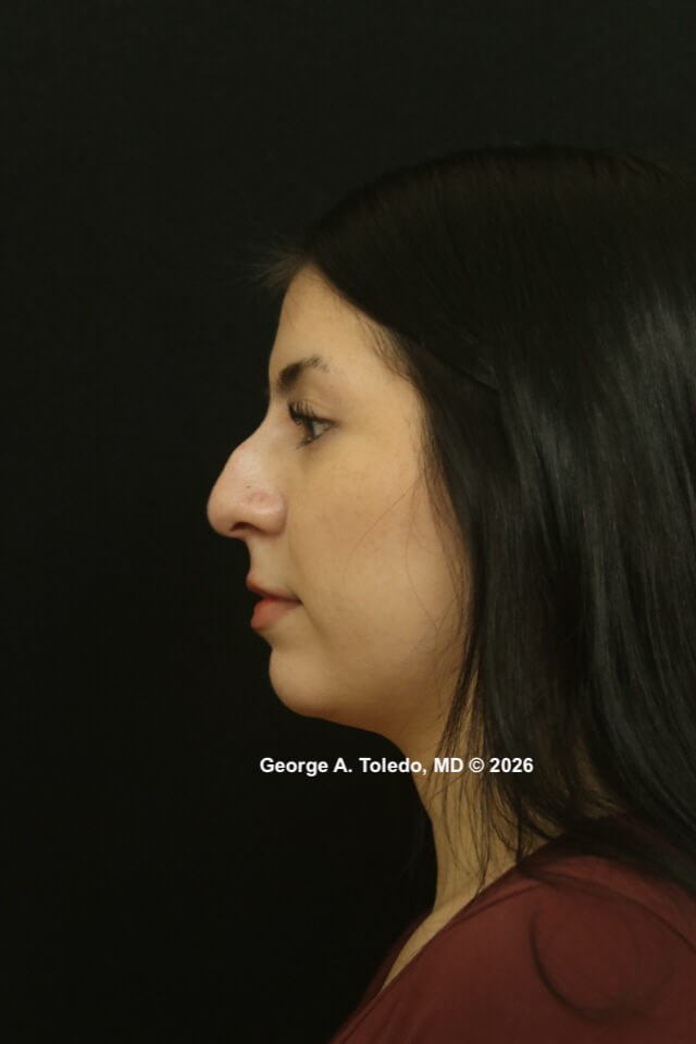 Rhinoplasty Before and Afters Before