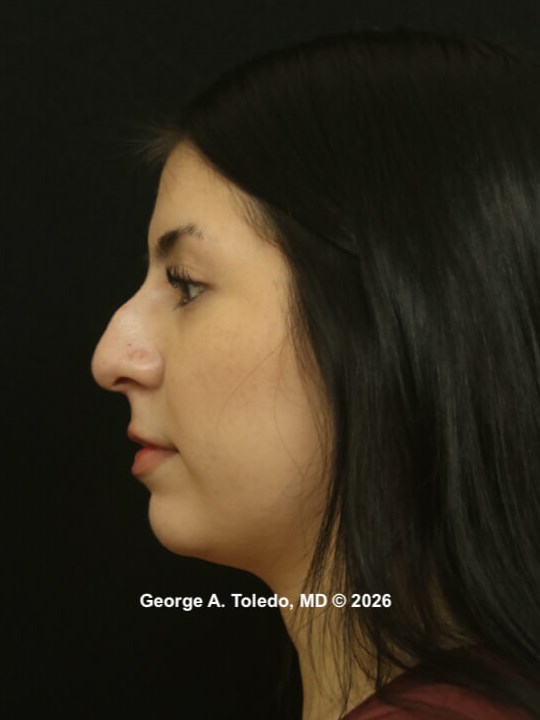 Rhinoplasty Before and Afters Before