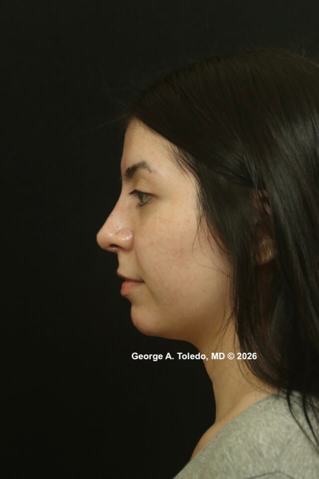 Rhinoplasty Before and Afters After