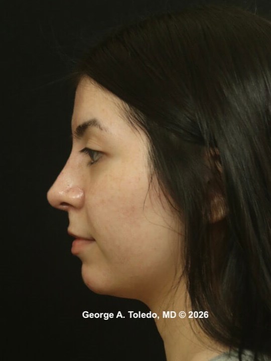 Rhinoplasty Before and Afters After