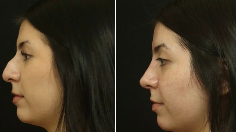 Natural Rhinoplasty Results
