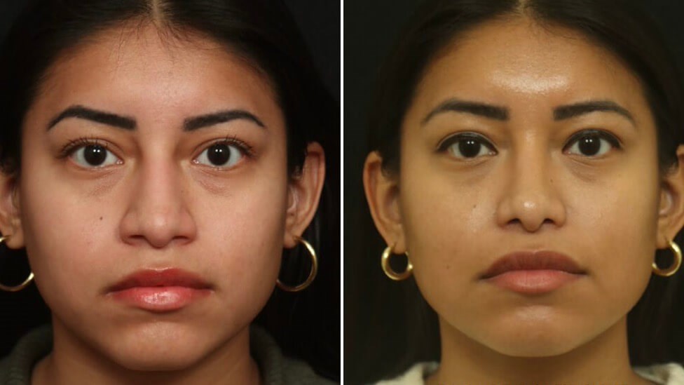 Ethnic Rhinoplasty Results