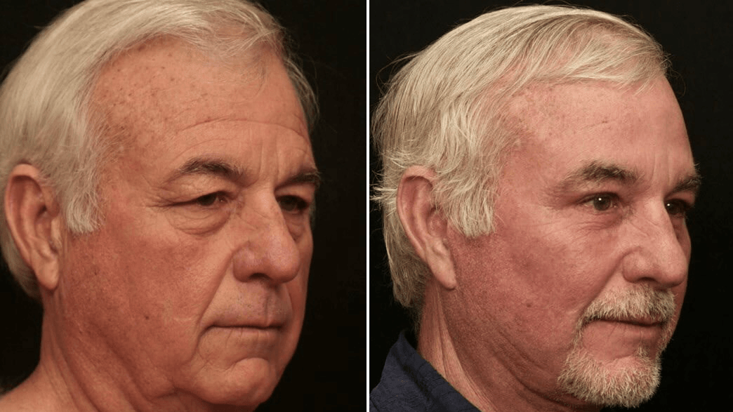 Eyelid Surgery 