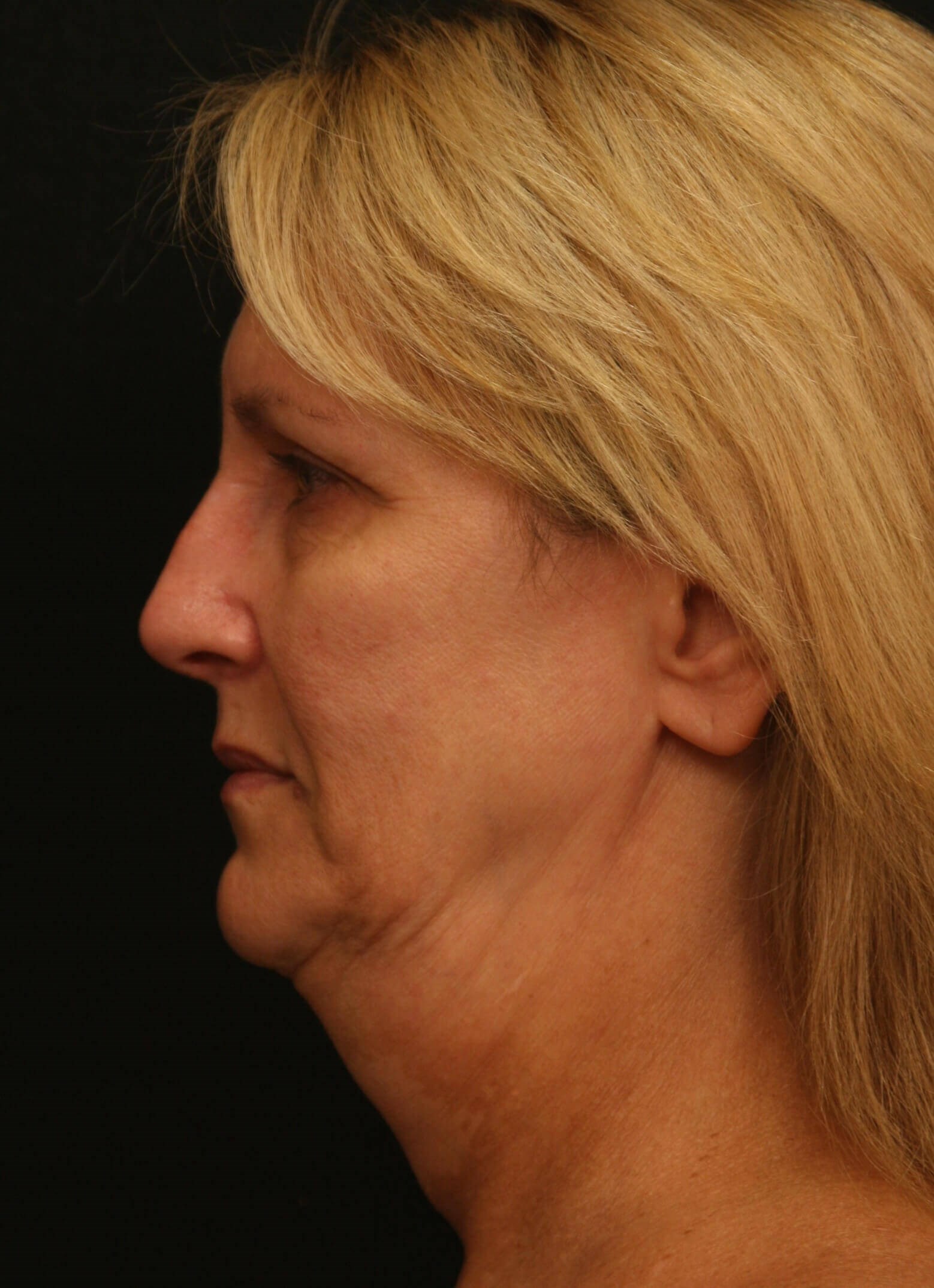 Facelift Before and After Before