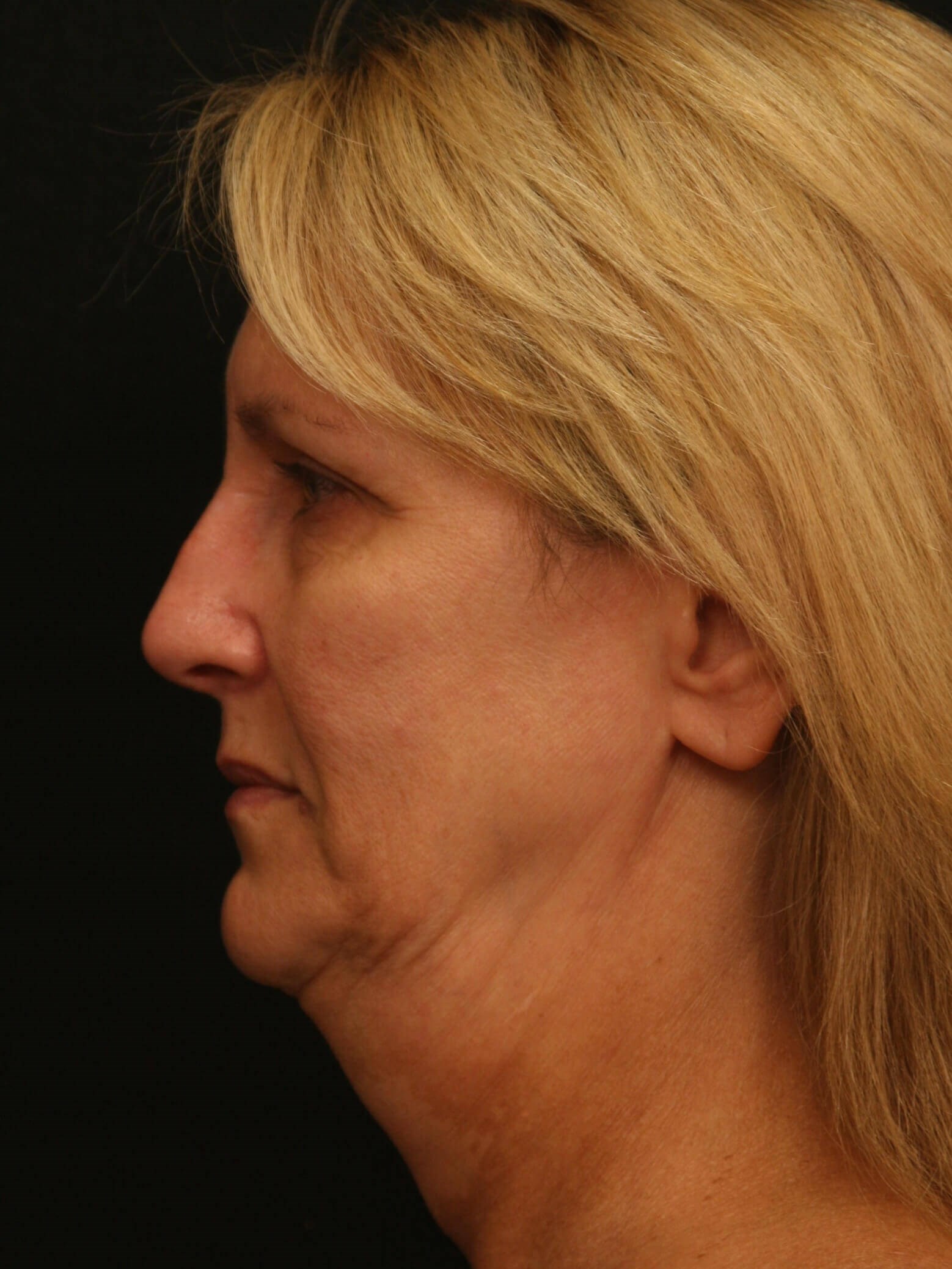 Facelift Before and After Before