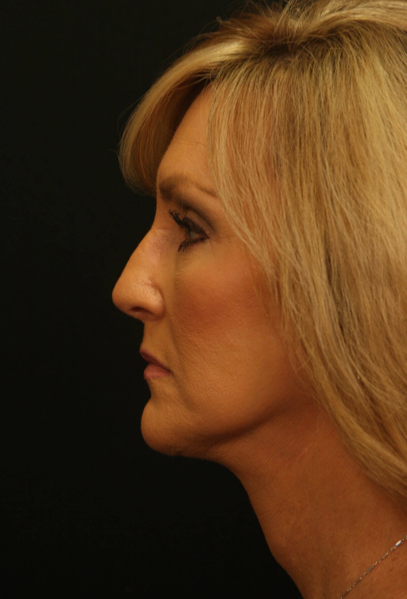 Facelift Before and After After