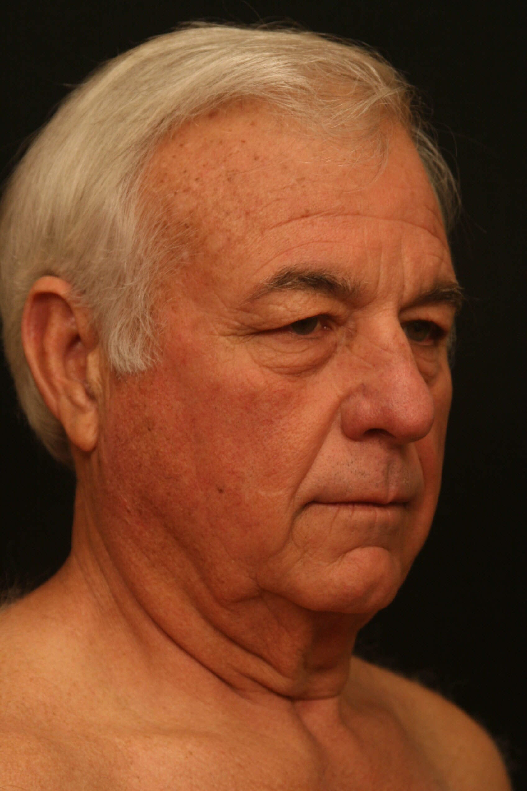 Facelift Before and After Before