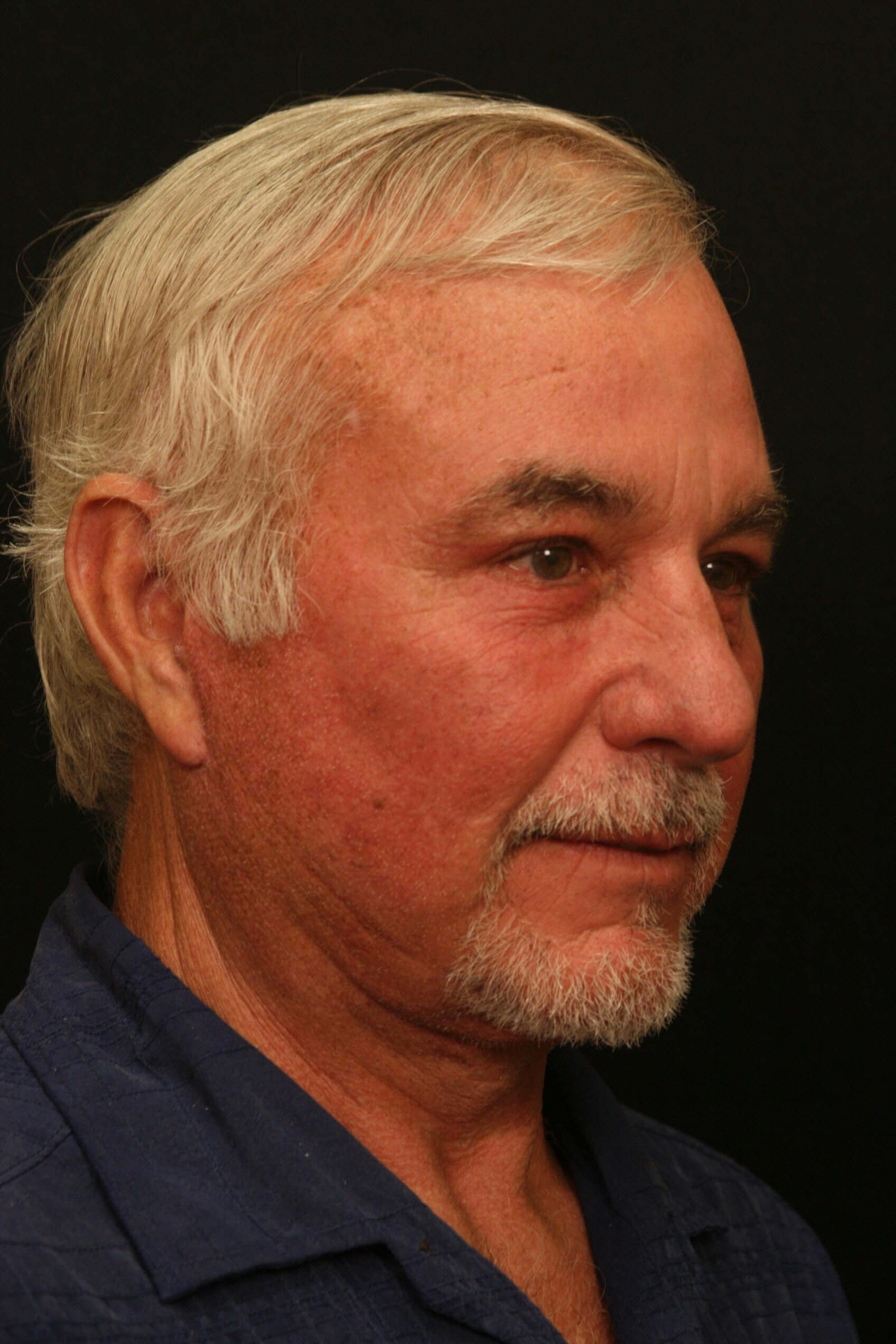 Facelift Before and After After