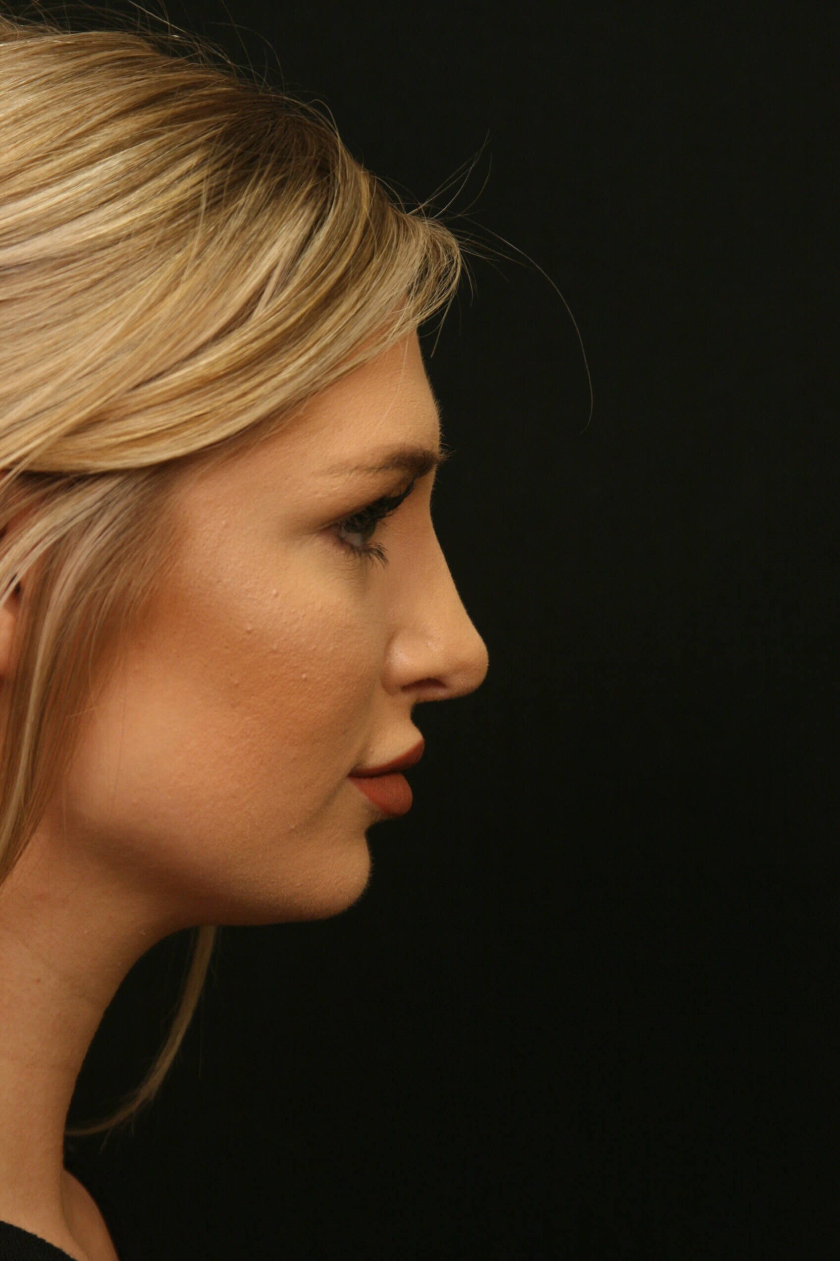 Rhinoplasty Before and After After