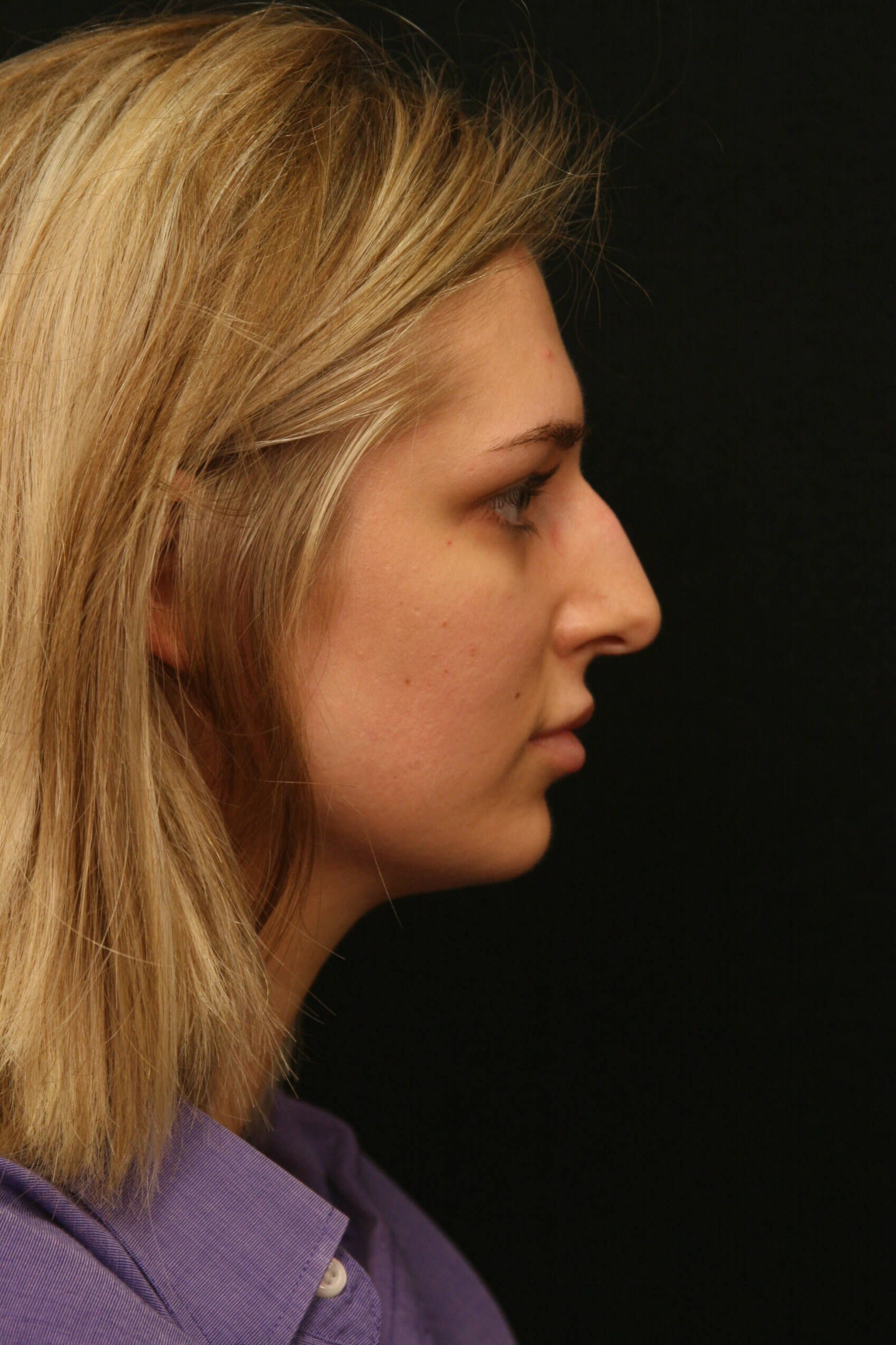 Rhinoplasty Before and After Before