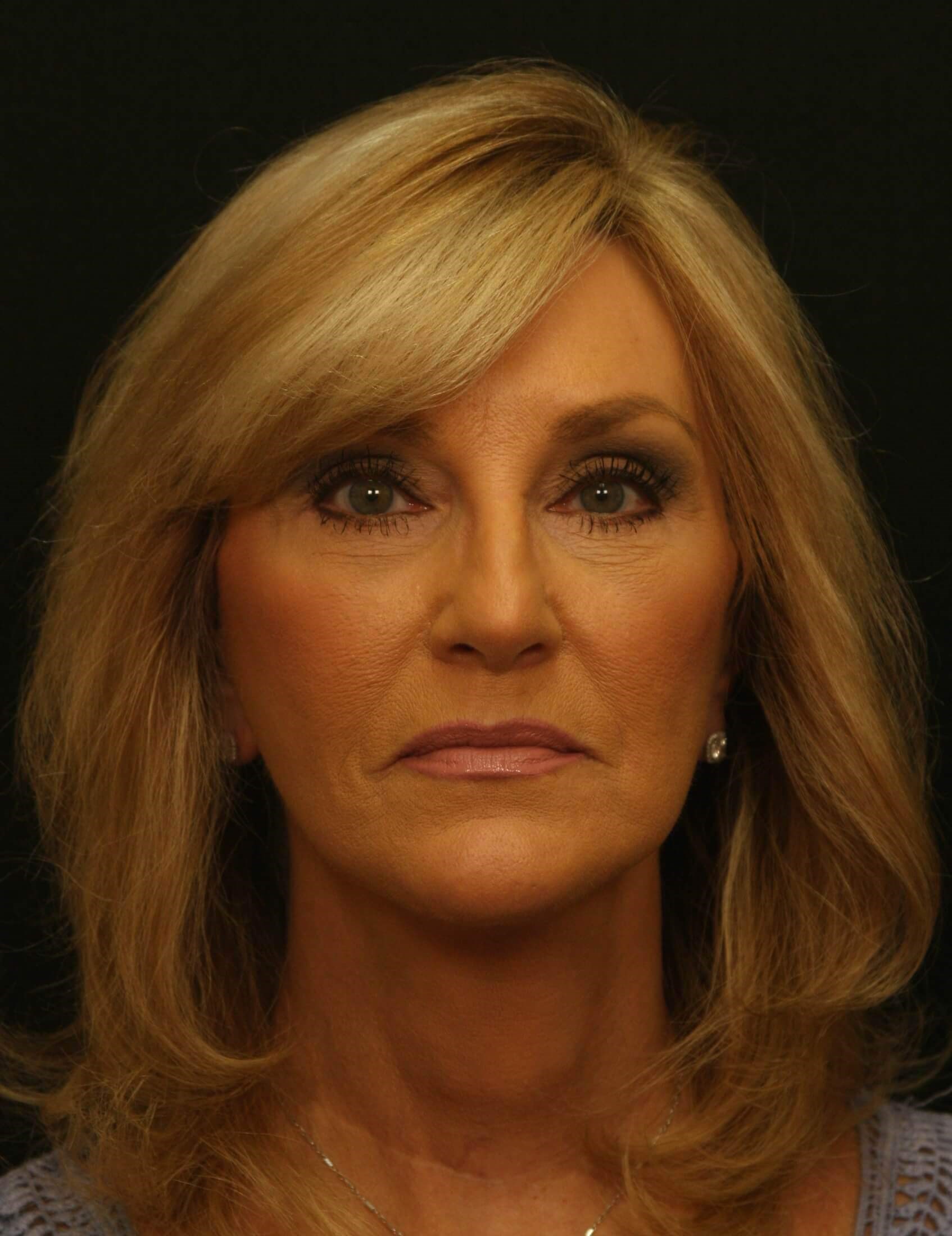 Facelift Before and After After