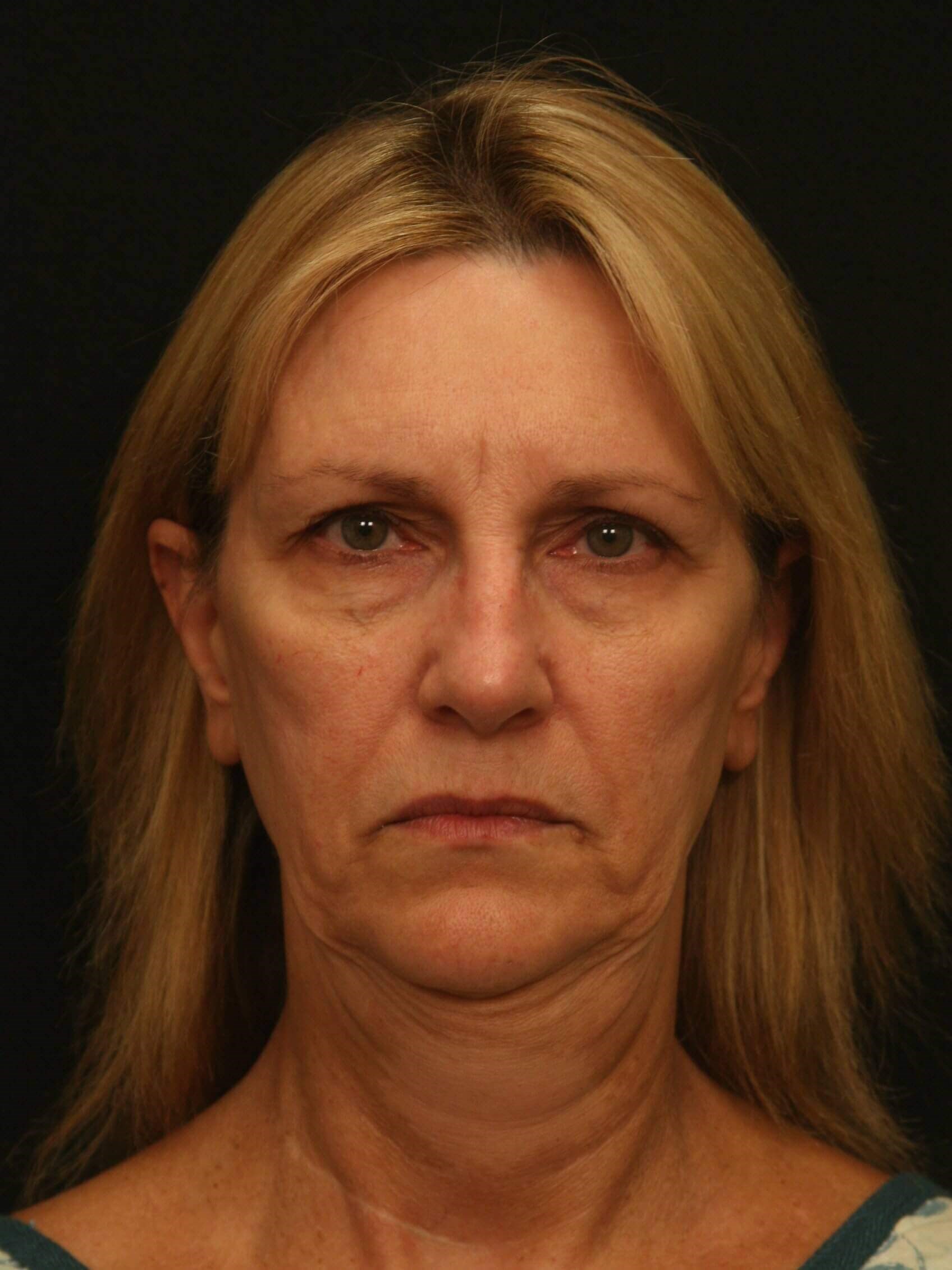 Facelift Before and After Before