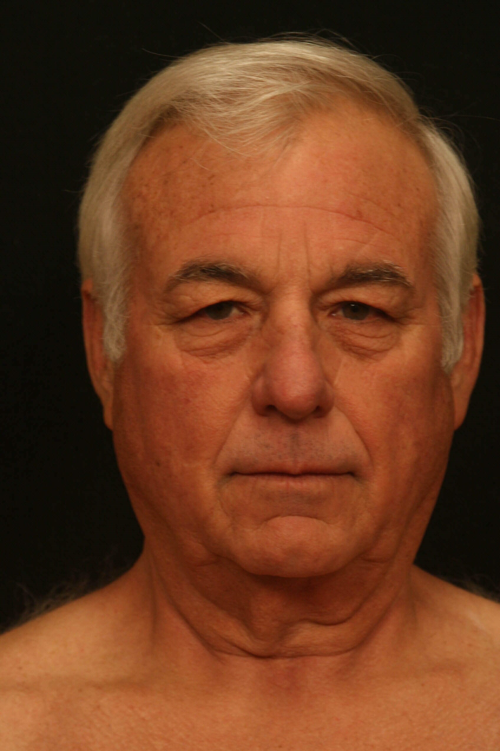 Facelift Before and After Before